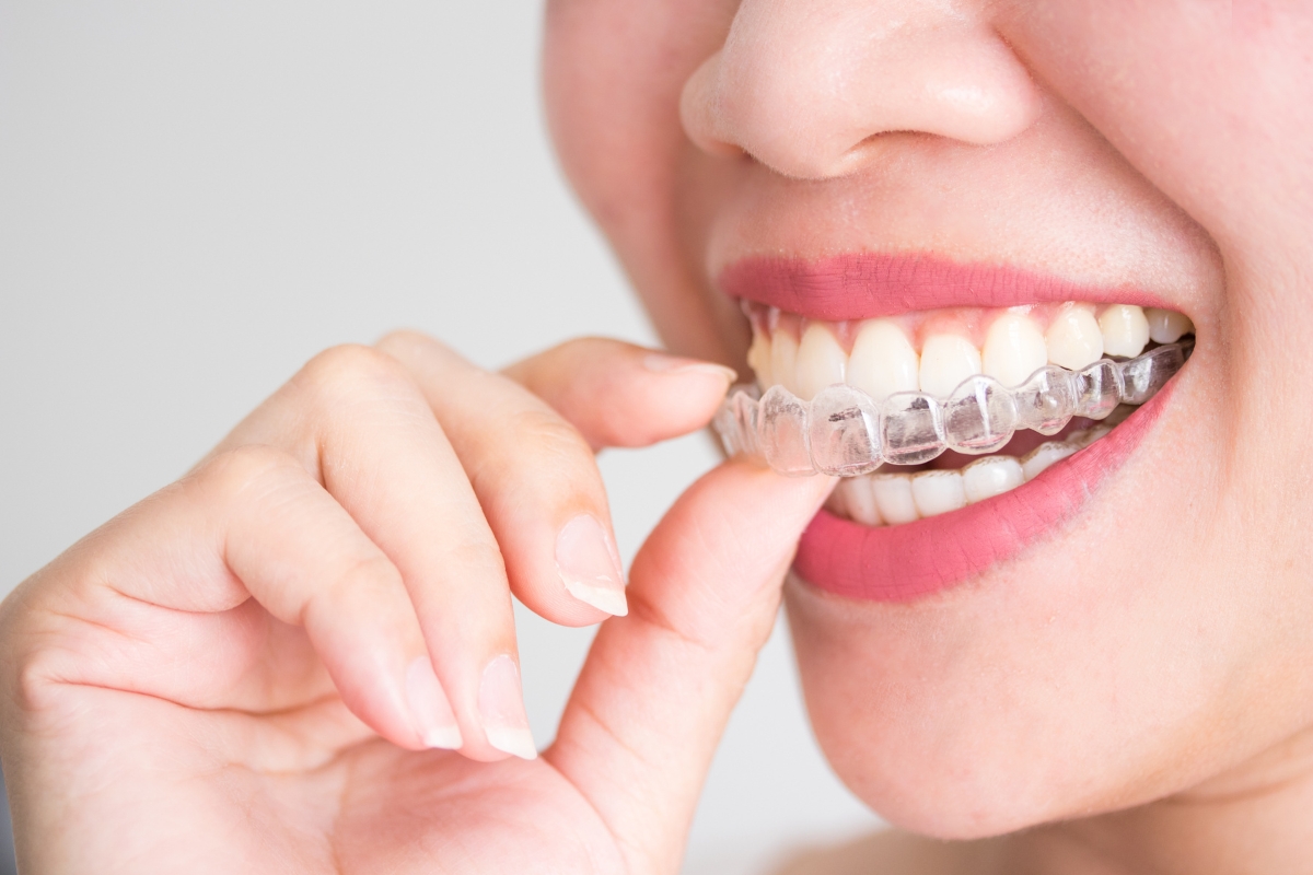 Invisalign-in-Nashville