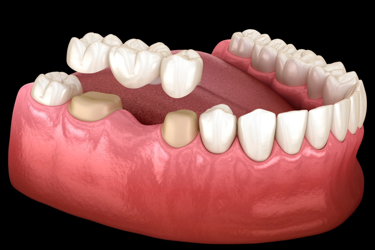 Dental Crowns Nashville